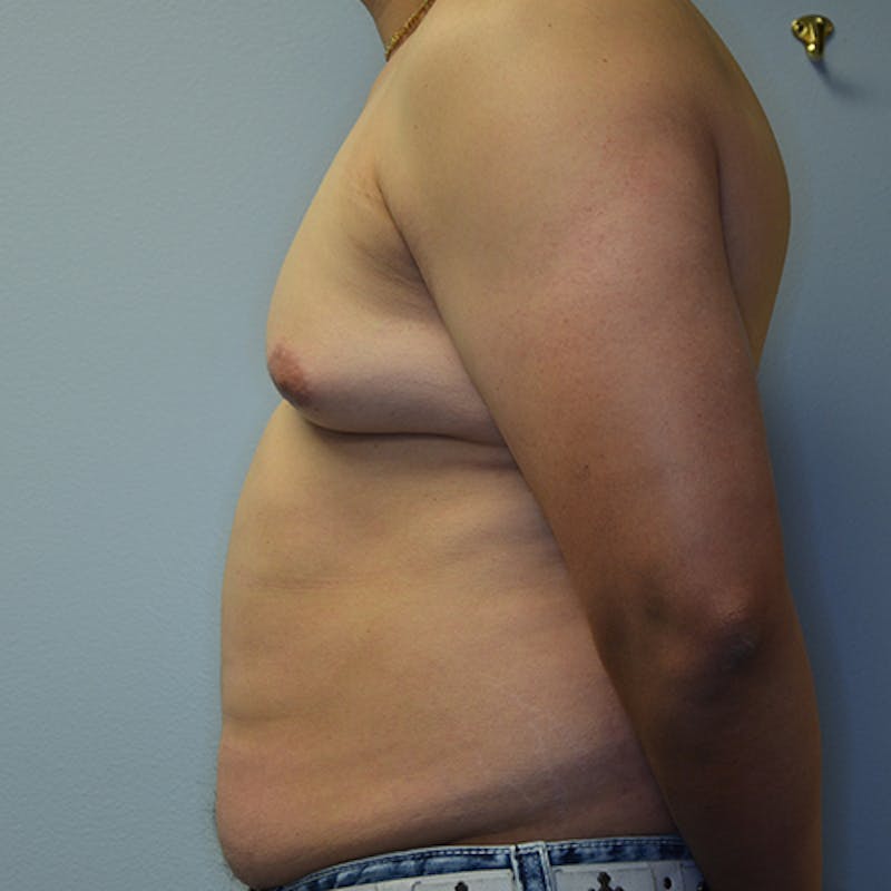 Gynecomastia Before & After Gallery - Patient 114721070 - Image 9