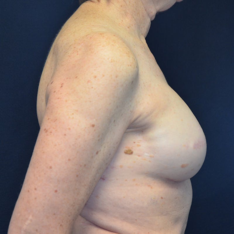 Breast Reconstruction Before & After Gallery - Patient 114721074 - Image 6