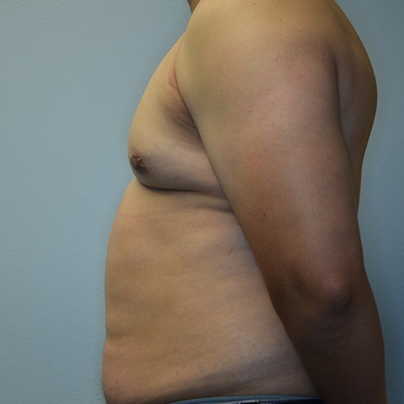 Gynecomastia Before & After Gallery - Patient 114721070 - Image 10