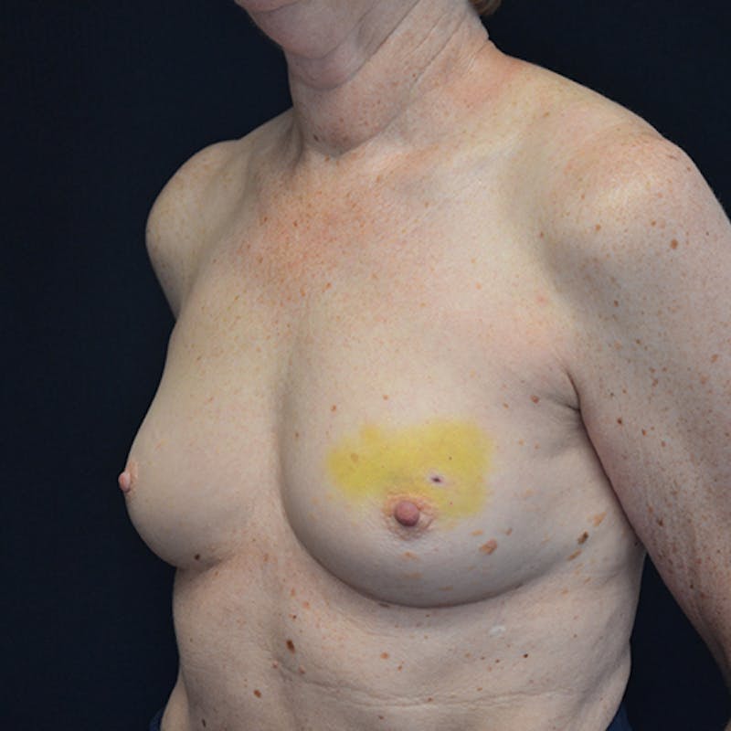 Breast Reconstruction Before & After Gallery - Patient 114721074 - Image 7