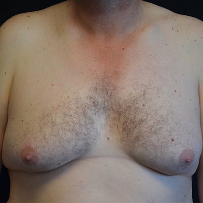 Gynecomastia Before & After Gallery - Patient 208342 - Image 1