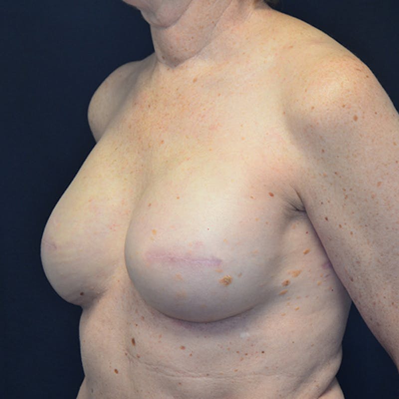 Breast Reconstruction Before & After Gallery - Patient 114721074 - Image 8