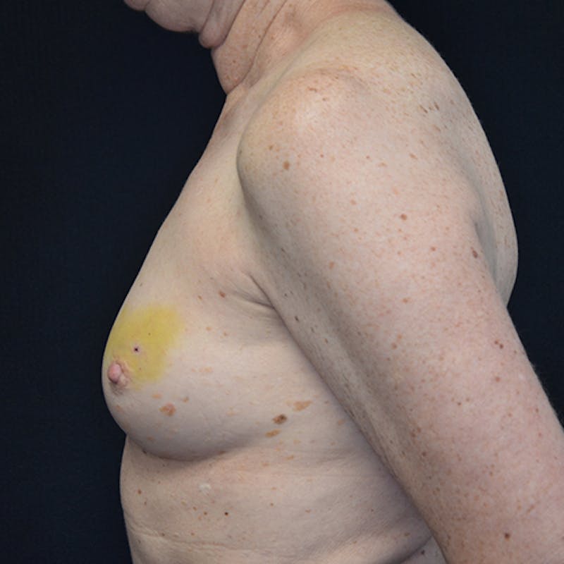 Breast Reconstruction Before & After Gallery - Patient 114721074 - Image 9