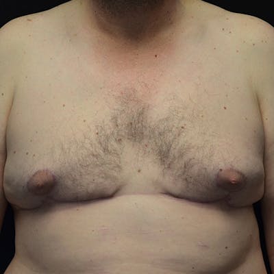 Gynecomastia Before & After Gallery - Patient 208342 - Image 2