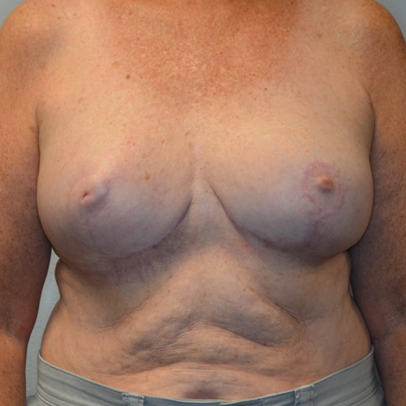 Breast Lift Before & After Gallery - Patient 114721078 - Image 2