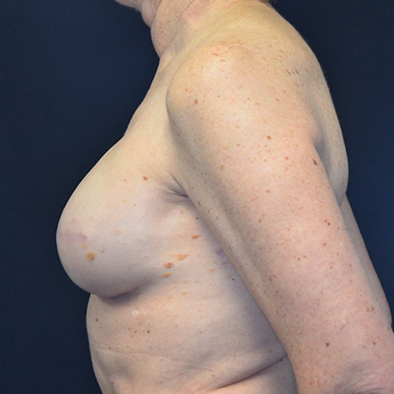 Breast Reconstruction Before & After Gallery - Patient 114721074 - Image 10