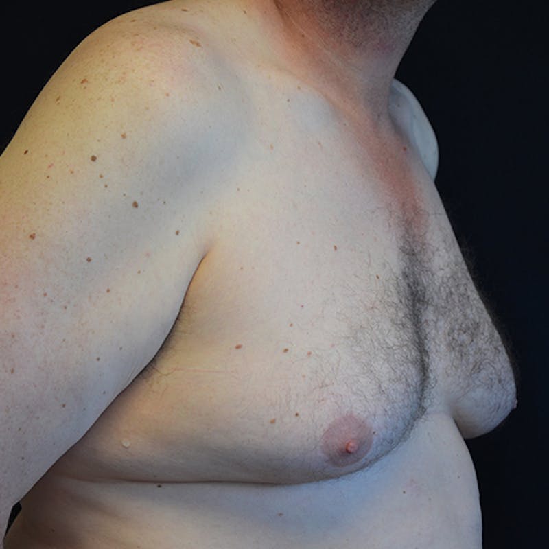 Gynecomastia Before & After Gallery - Patient 116789590 - Image 3