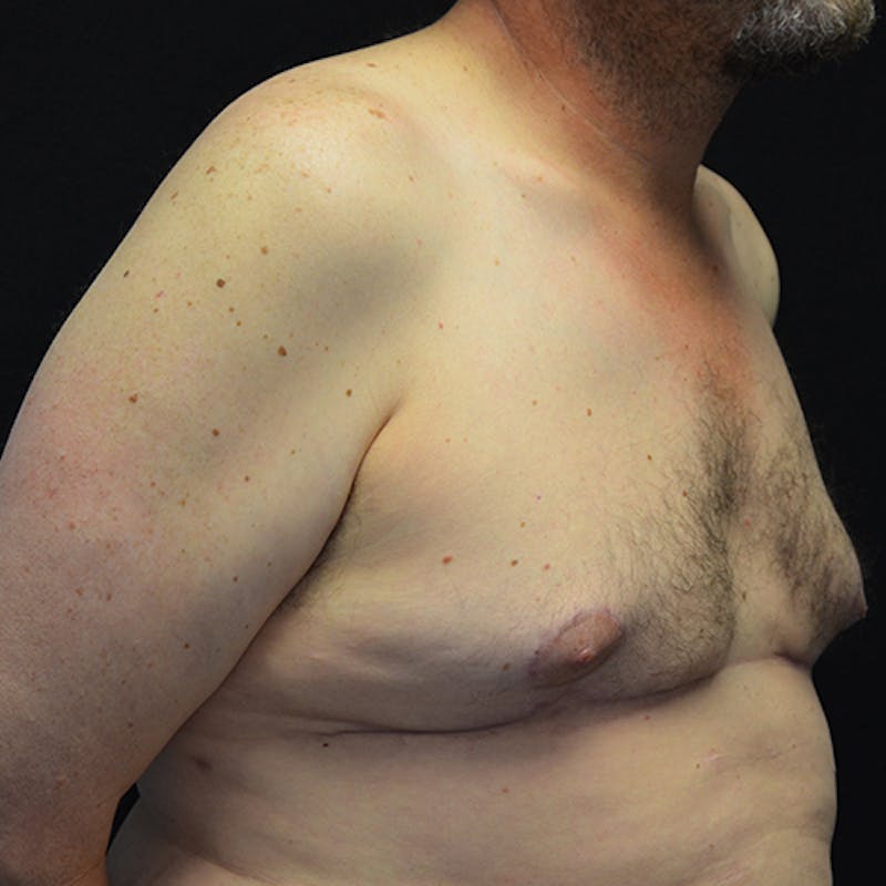 Gynecomastia Before & After Gallery - Patient 116789590 - Image 4