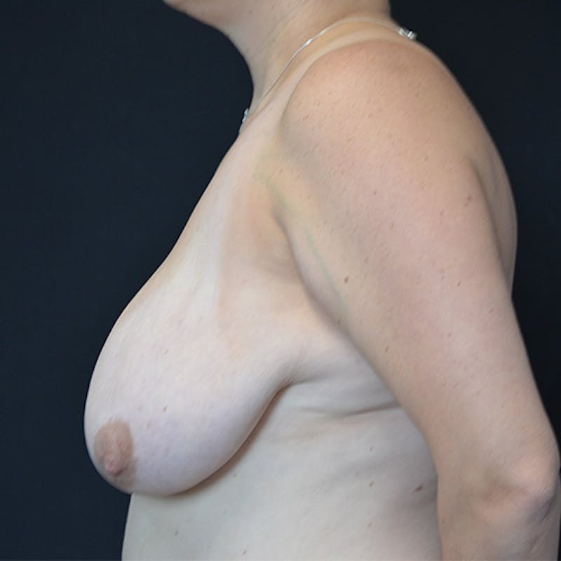 Breast Reduction Before & After Gallery - Patient 114721076 - Image 5
