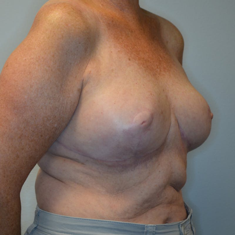 Breast Lift Before & After Gallery - Patient 114721078 - Image 4
