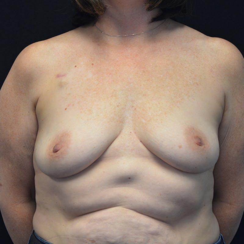 Breast Reconstruction Before & After Gallery - Patient 114721080 - Image 1