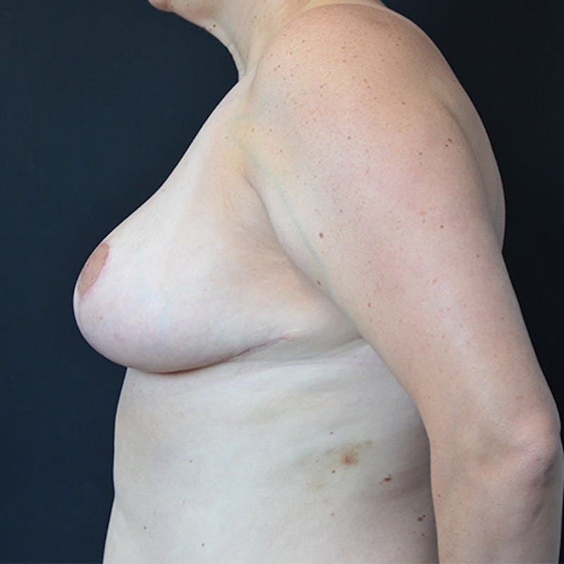Breast Reduction Before & After Gallery - Patient 114721076 - Image 6