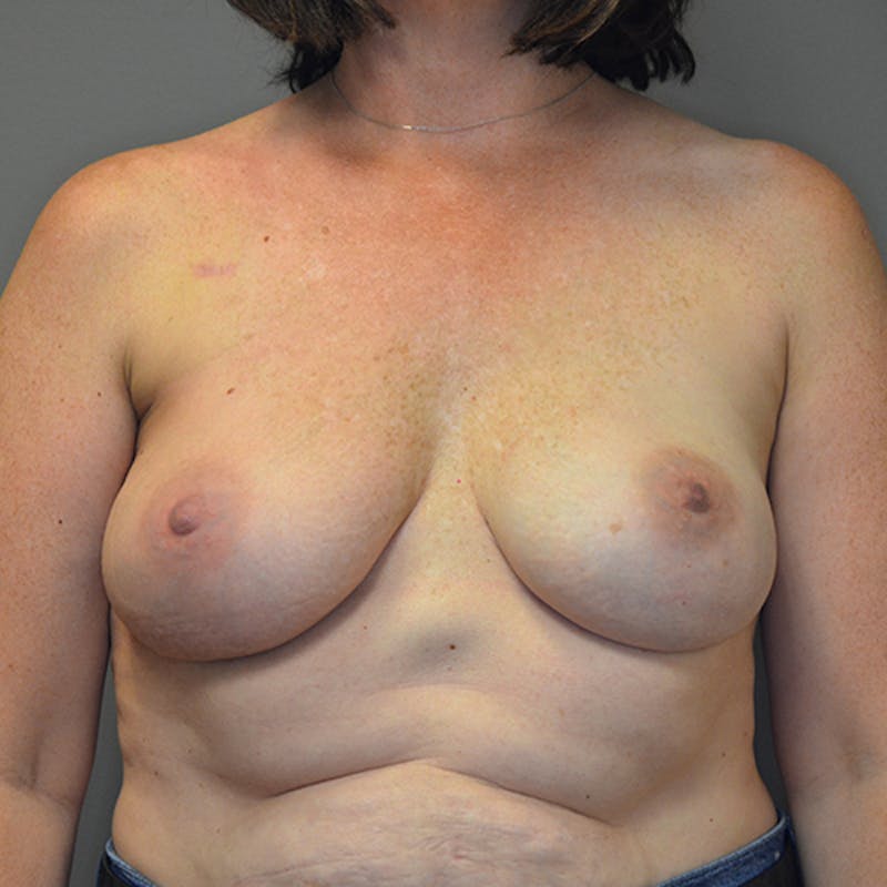 Breast Reconstruction Before & After Gallery - Patient 114721080 - Image 2