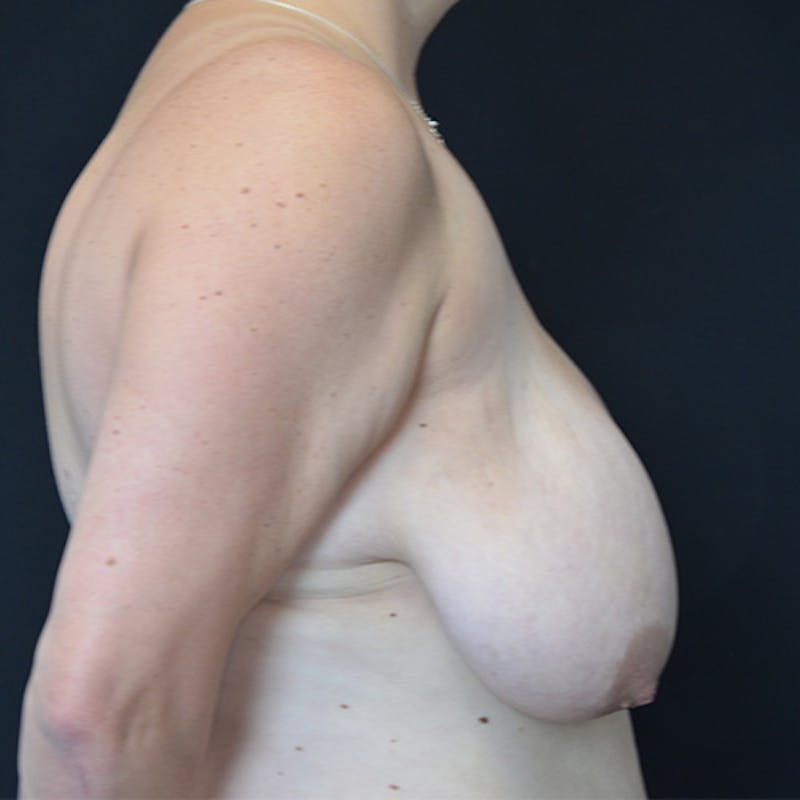 Breast Reduction Before & After Gallery - Patient 114721076 - Image 7