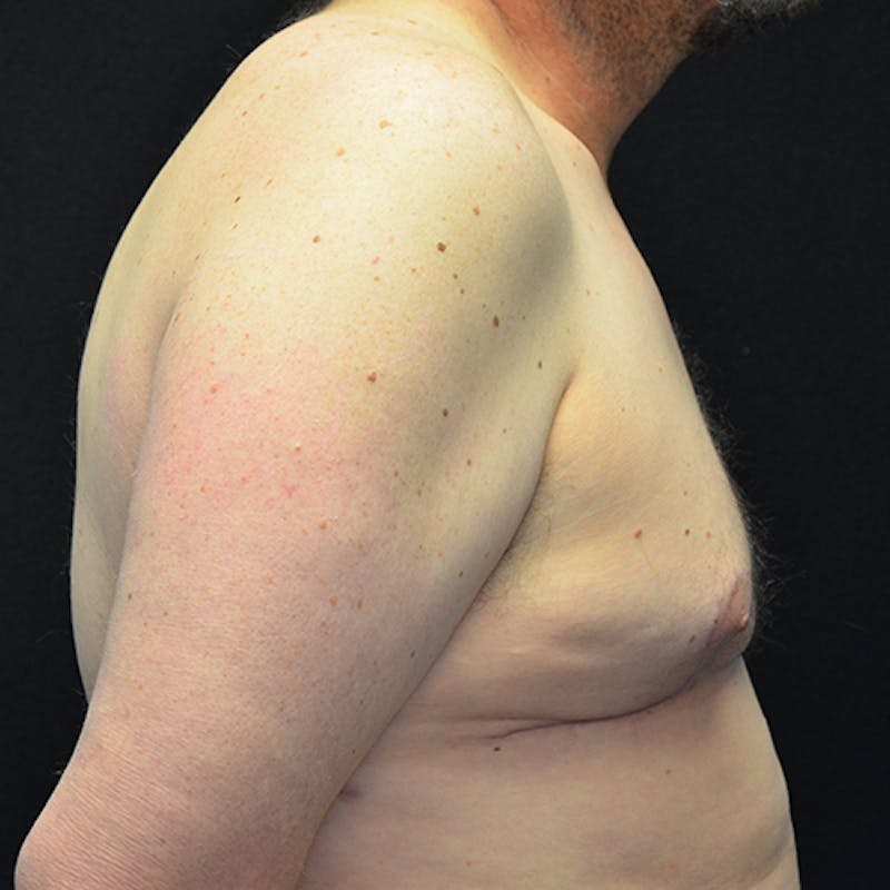 Gynecomastia Before & After Gallery - Patient 114721077 - Image 6