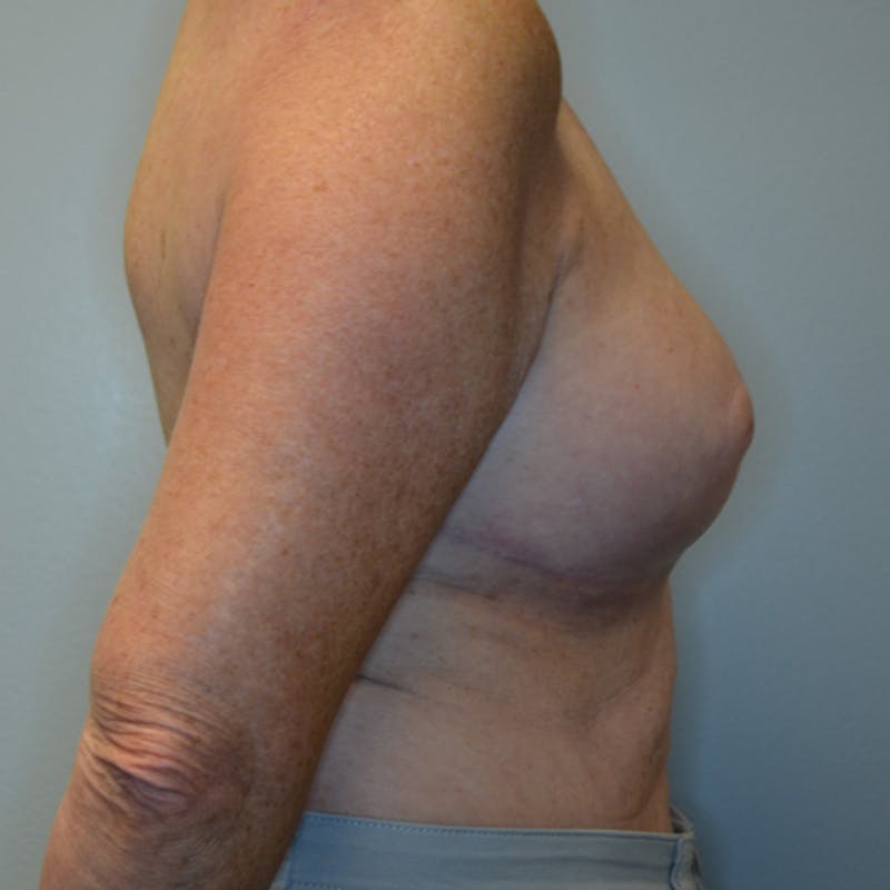 Breast Lift Before & After Gallery - Patient 114721078 - Image 6