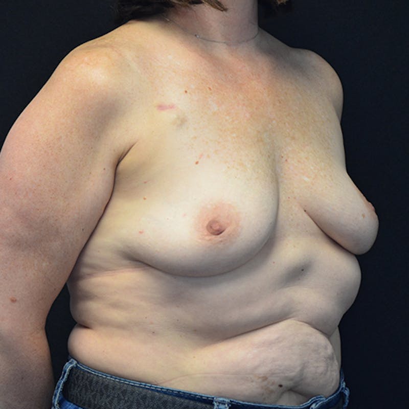 Breast Reconstruction Before & After Gallery - Patient 114721080 - Image 3