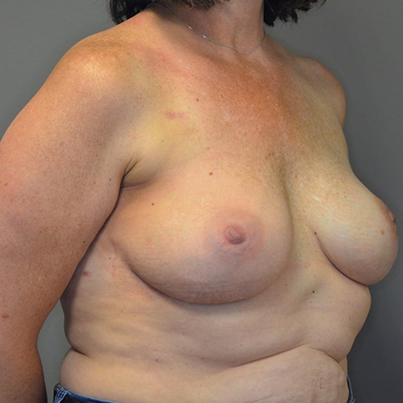 Breast Reconstruction Before & After Gallery - Patient 114721080 - Image 4