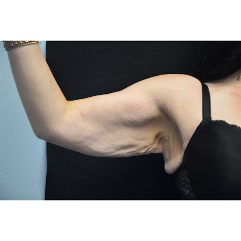 Arm Lift Before & After Gallery - Patient 114721081 - Image 3