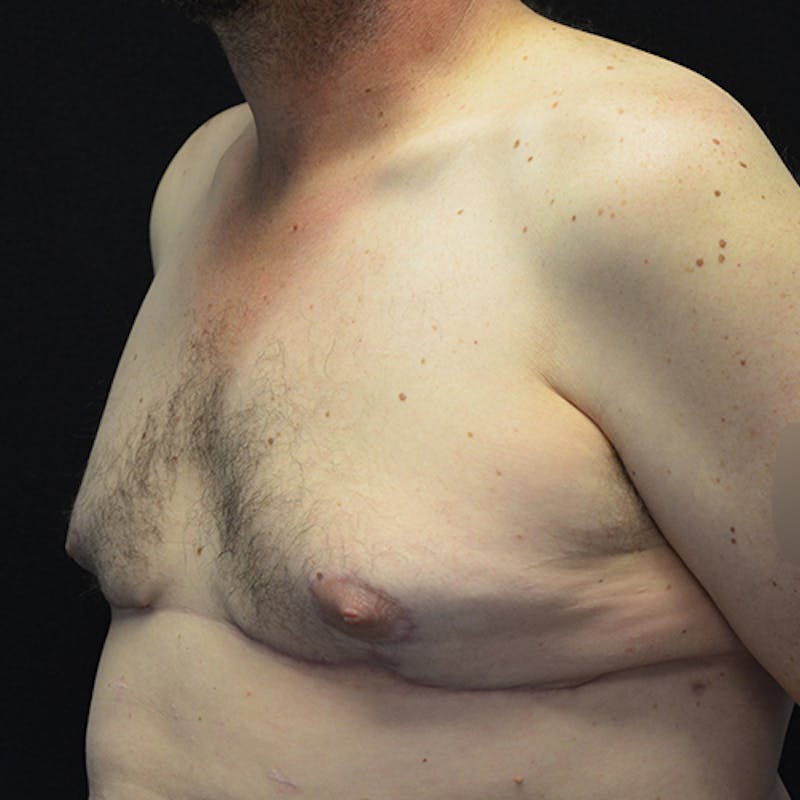 Gynecomastia Before & After Gallery - Patient 116789590 - Image 8