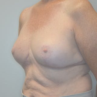 Breast Lift Before & After Gallery - Patient 114721078 - Image 8
