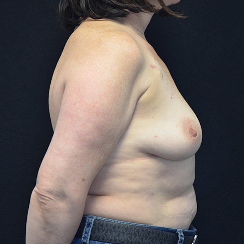 Breast Reconstruction Before & After Gallery - Patient 114721080 - Image 5