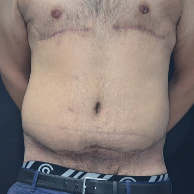 Body Lift Before & After Gallery - Patient 114721084 - Image 2