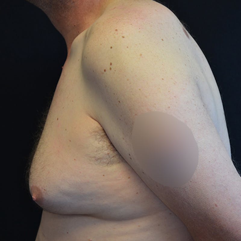 Gynecomastia Before & After Gallery - Patient 208342 - Image 9