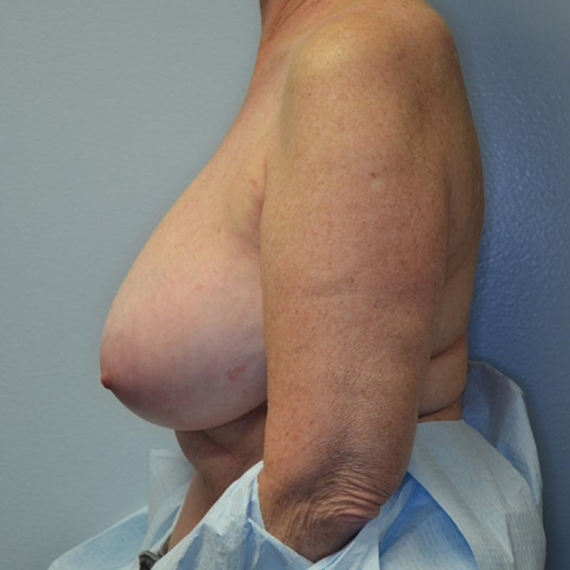 Breast Lift Before & After Gallery - Patient 114721078 - Image 9