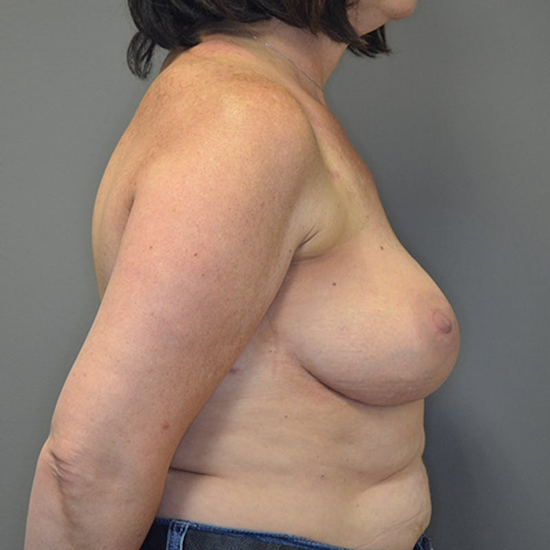 Breast Reconstruction Before & After Gallery - Patient 114721080 - Image 6
