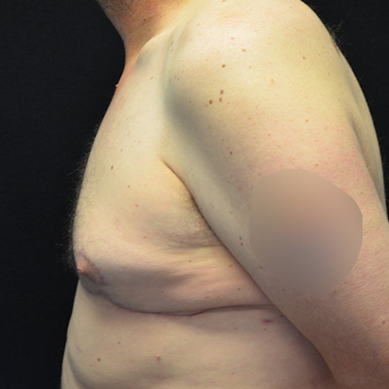 Gynecomastia Before & After Gallery - Patient 208342 - Image 10