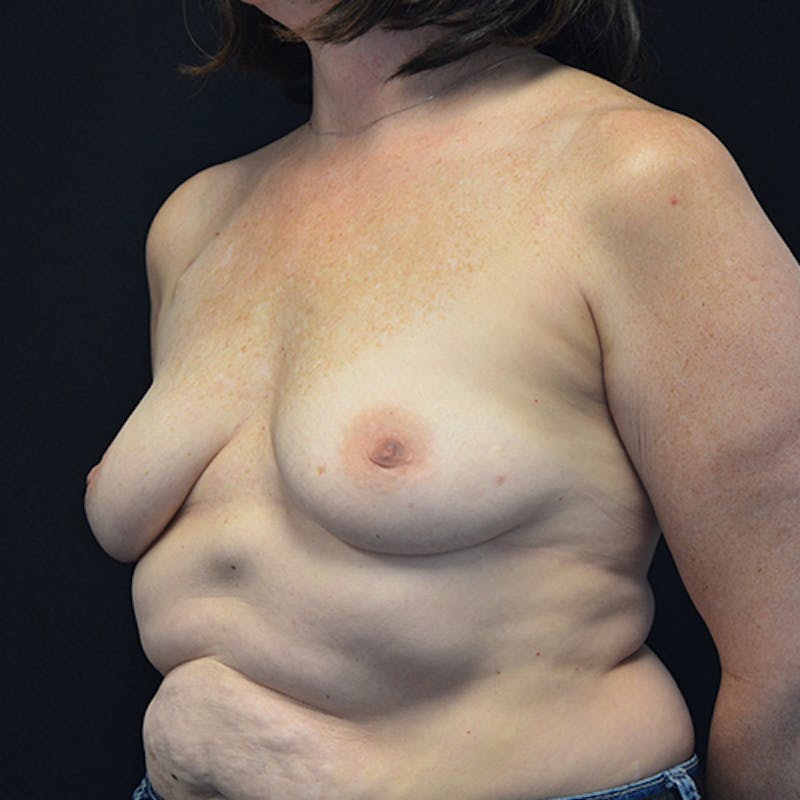 Breast Reconstruction Before & After Gallery - Patient 114721080 - Image 7