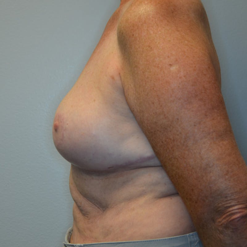 Breast Lift Before & After Gallery - Patient 114721078 - Image 10