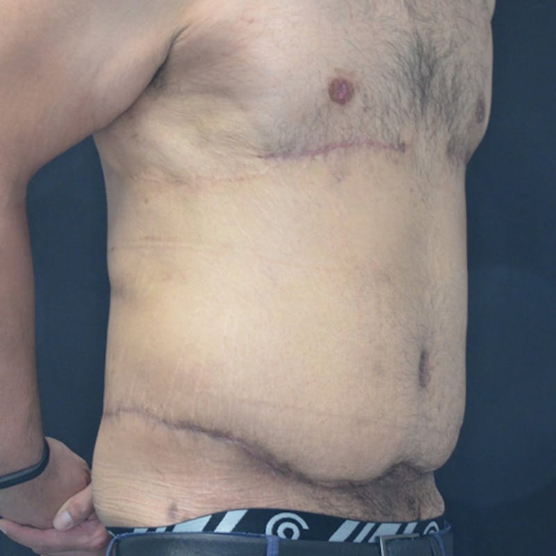 Body Lift Before & After Gallery - Patient 114721084 - Image 4