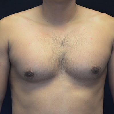 Gynecomastia Before & After Gallery - Patient 906159 - Image 1
