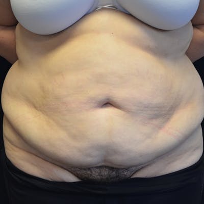 Fleur de lis Abdominoplasty Before & After Gallery - Patient 114721085 - Image 1