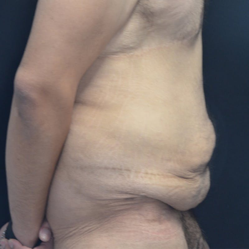 Body Lift Before & After Gallery - Patient 114721084 - Image 5