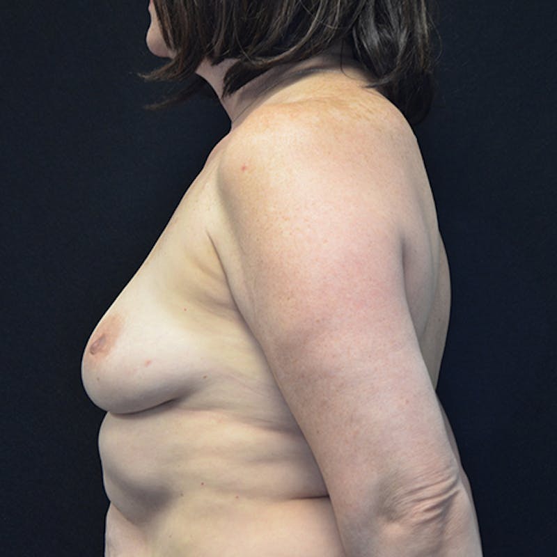 Breast Reconstruction Before & After Gallery - Patient 114721080 - Image 9