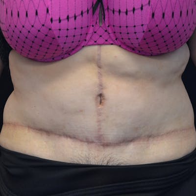 Fleur de lis Abdominoplasty Before & After Gallery - Patient 114721085 - Image 2