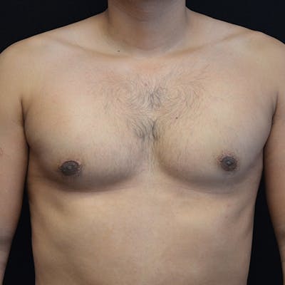 Gynecomastia Before & After Gallery - Patient 114721086 - Image 2