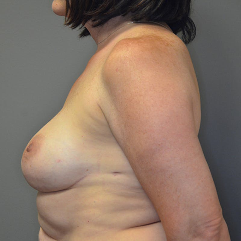 Breast Reconstruction Before & After Gallery - Patient 114721080 - Image 10