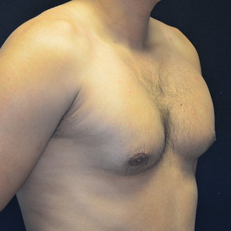 Gynecomastia Before & After Gallery - Patient 906159 - Image 3