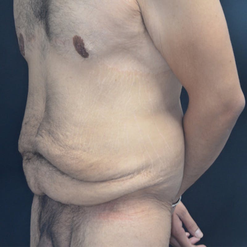 Body Lift Before & After Gallery - Patient 114721084 - Image 7