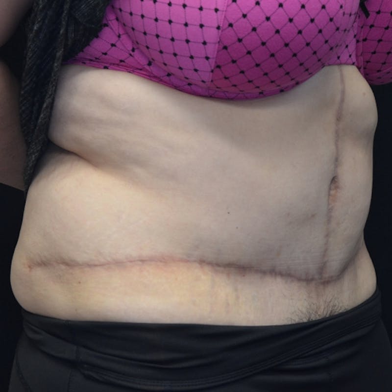 Fleur de lis Abdominoplasty Before & After Gallery - Patient 114721085 - Image 4