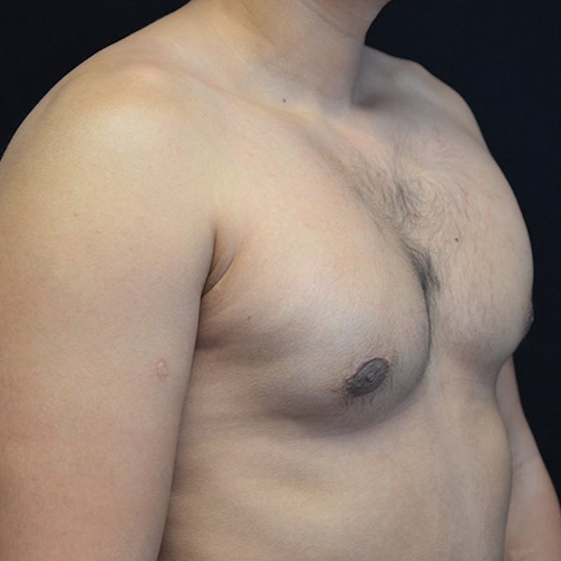 Gynecomastia Before & After Gallery - Patient 906159 - Image 4