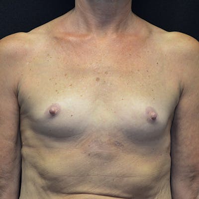 Breast Reconstruction Before & After Gallery - Patient 114721090 - Image 1