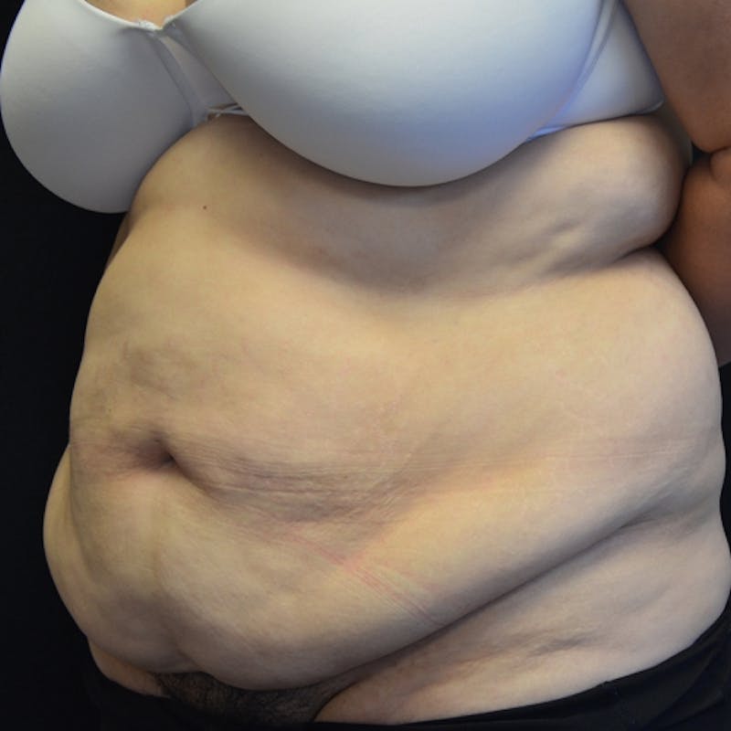 Fleur de lis Abdominoplasty Before & After Gallery - Patient 114721085 - Image 5