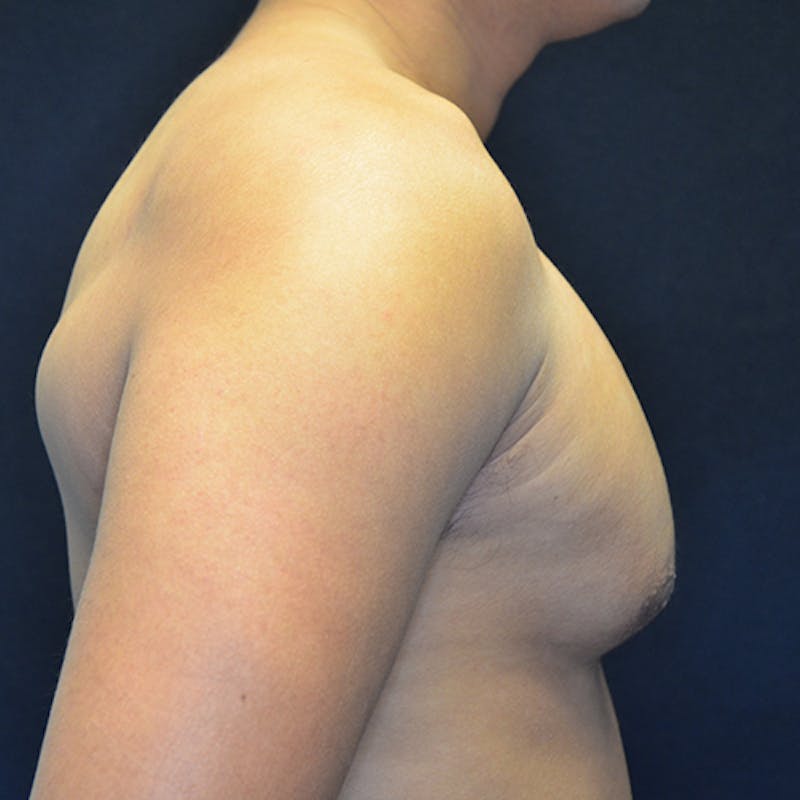 Gynecomastia Before & After Gallery - Patient 906159 - Image 5