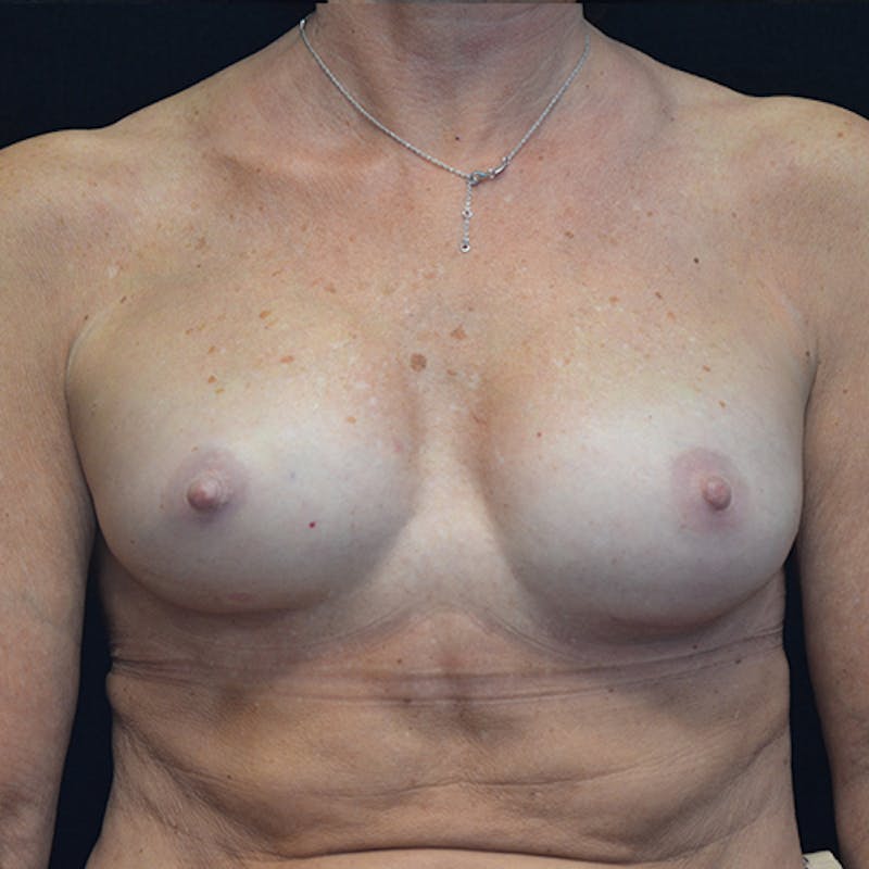 Breast Reconstruction Before & After Gallery - Patient 114721090 - Image 2