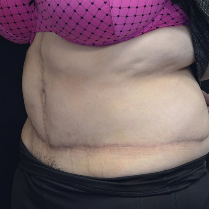 Fleur de lis Abdominoplasty Before & After Gallery - Patient 114721085 - Image 6